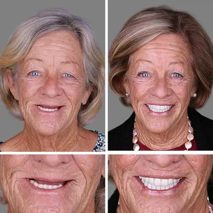 Ends Today: 70% OFF! ⏰ KLENIMORE™ Custom-Fit Smile Support Set — Strong Hold & Natural Look 🦷